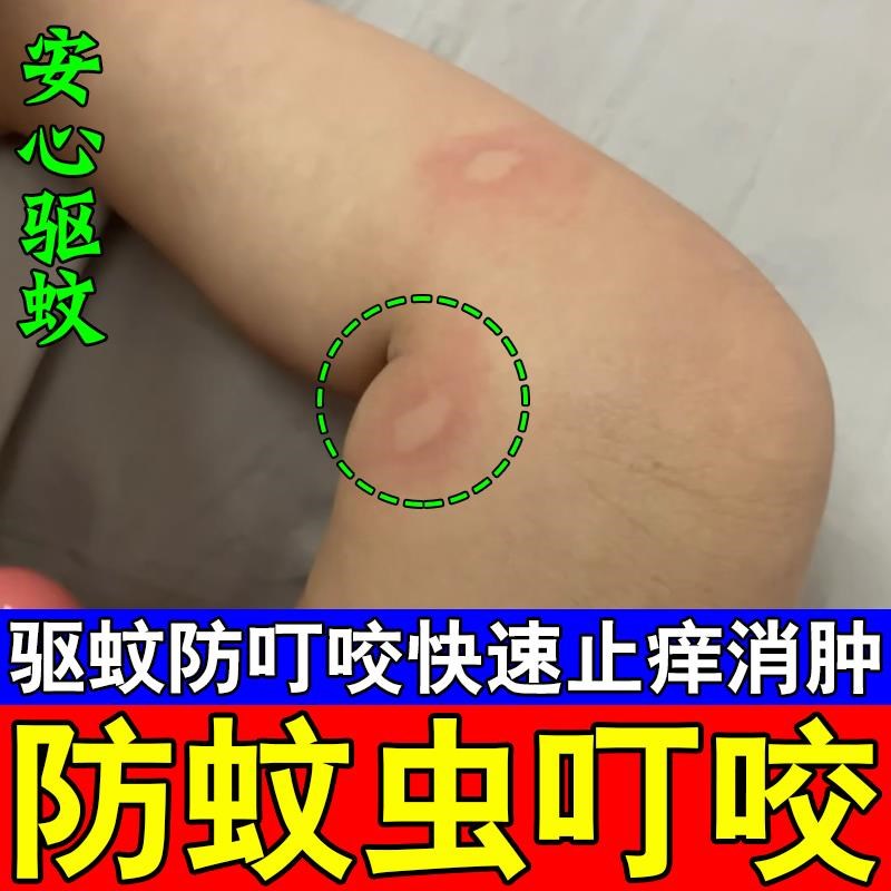 止痒膏蚊虫叮咬螨虫叮咬药膏蚂蚁咬伤药膏红火蚁隐翅虫毒虫跳蚤叮