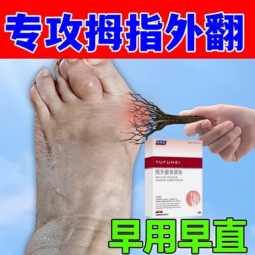 拇囊炎疼痛拇指外翻药膏贴大脚趾拇外翻矫正专用贴纠正脚趾神器
