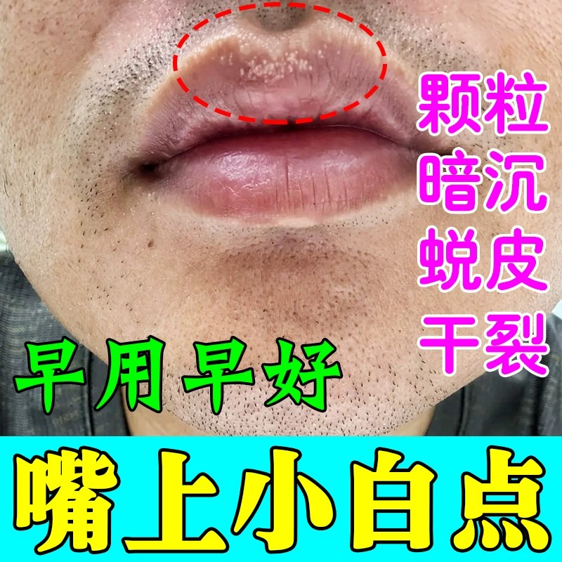 皮脂腺异位症嘴唇白点脂肪小颗粒越长越多干燥裂脱皮暗沉嘴巴增生