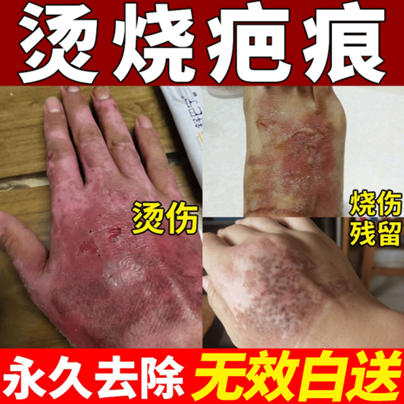 烫伤去疤膏烧伤疤痕修复油去黑印色素沉淀祛疤膏除疤正品修复膏