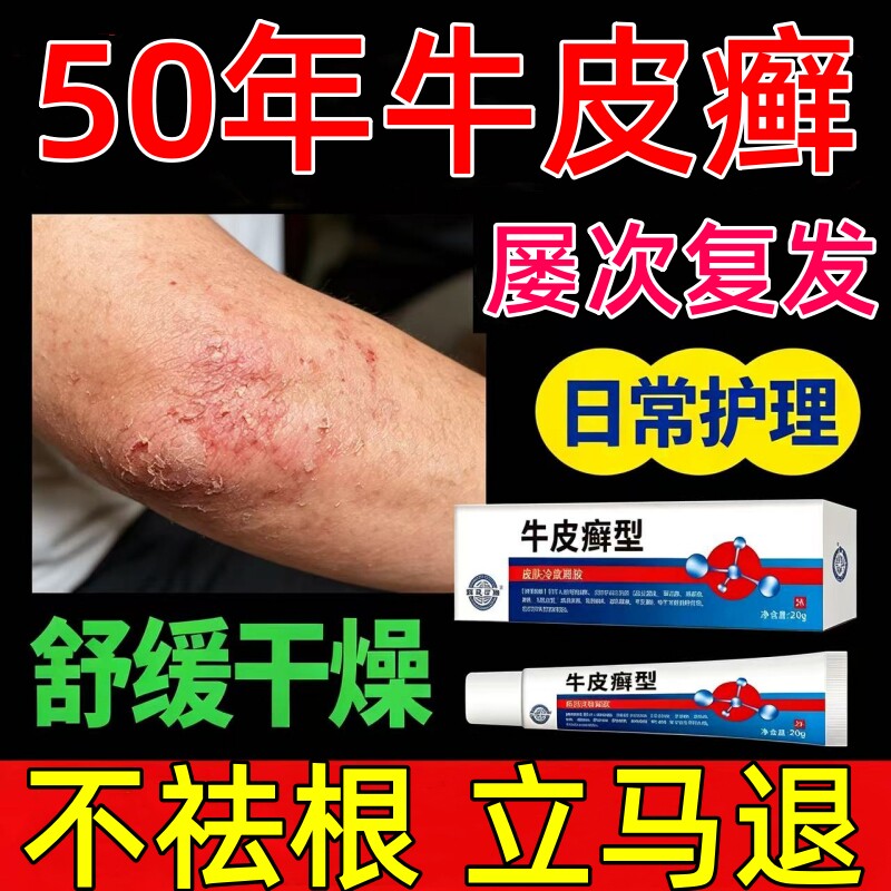 牛皮癣药膏牛皮藓银屑病真菌感染药膏脚廯止痒抑菌外用皮肤病OA