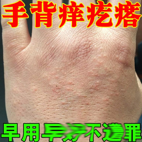 皮肤专用手背长疙瘩日光性手上起小疙瘩外用软膏