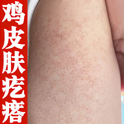 手臂鸡皮疙瘩颗粒粗糙红点黑点颗粒全身胳膊外用软乳霜