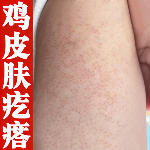 小孩手臂红点鸡皮疙瘩颗粒粗糙黑点颗粒全身胳膊外用软乳霜