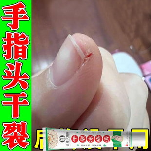手指头裂口子脱皮粗糙开裂疼痛治指甲缝边缘干裂膏愈合修复霜冬天