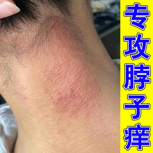 脖子后面发痒长红斑刺挠颈部上起红疙瘩红点外用修复膏