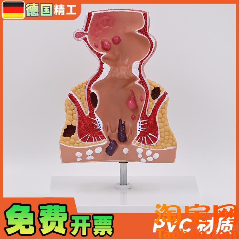 原装适用德国】新款大促爆款人体模型肠直肠解剖病理模型病态疾病