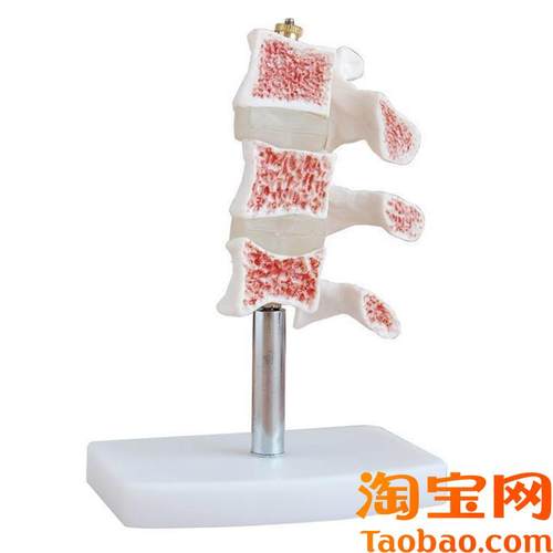 脊椎典型病变模型,脊椎模型,解剖模型H,骨质疏松关节模型骨骼模型