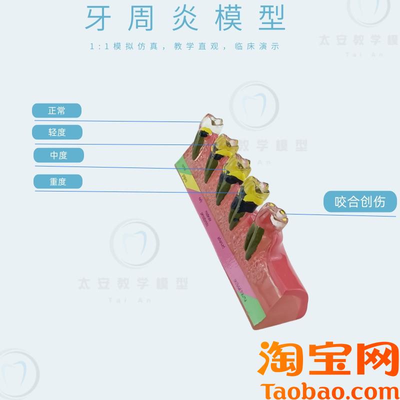 原装适用牙科口腔牙周炎演变模型牙龈蛀牙龋齿模型厂家直销牙齿模