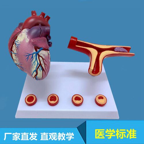 心血管病理模型冠状动脉s粥样硬化狭窄内膜斑块脱落临床医患医药