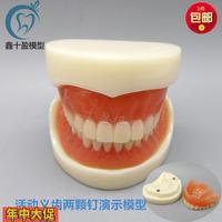 牙科模型活動義齒牙模講解模型全口義齒兩顆釘教學(xué)模型T21包郵