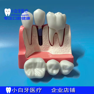 口腔牙模型4倍种植解说模型牙冠可卸种植钉展示模型 医患沟通模型