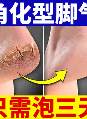 角化型脚气脚后跟开裂干裂真菌感染脱皮专用治角质型