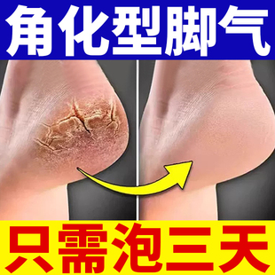 角化型脚气脚后跟开裂干裂真菌感染脱皮专用治角质型