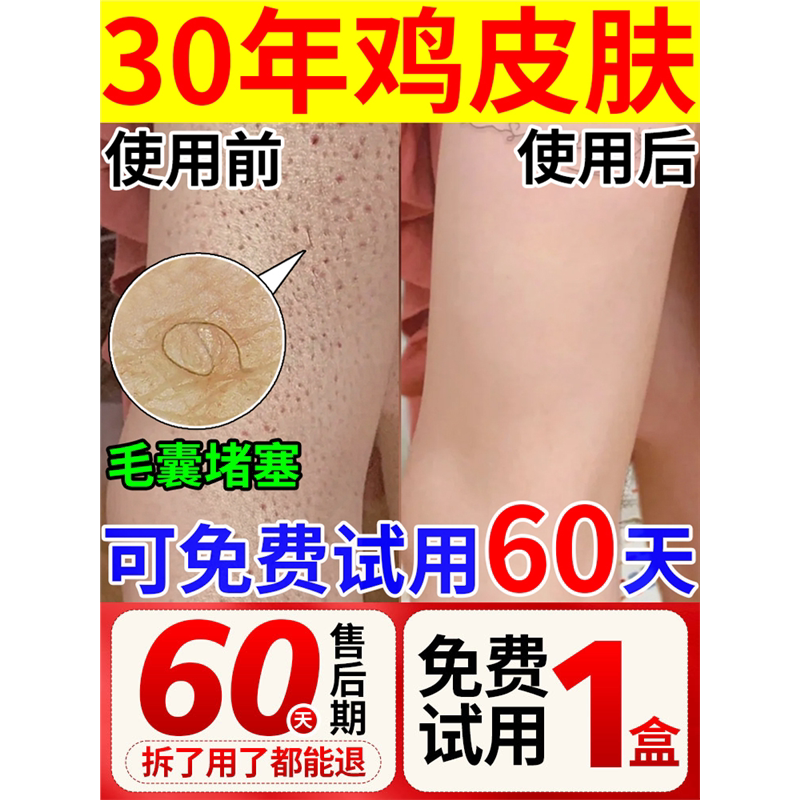 鸡皮肤疙瘩毛囊角化药膏去除神器儿童全身手臂腿改善鱼鳞蛇角质症