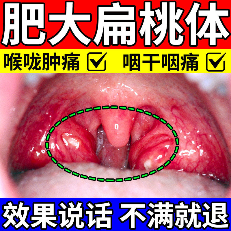 扁桃体肥大肿大贴治疗儿童咽喉肿痛喉咙发炎化脓克星专用药贴神器