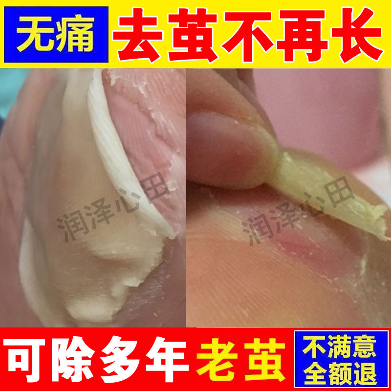 老茧脚底脚趾滴茧乐去茧立乐手足茧护理抗菌厚平乐立净液洁士土结