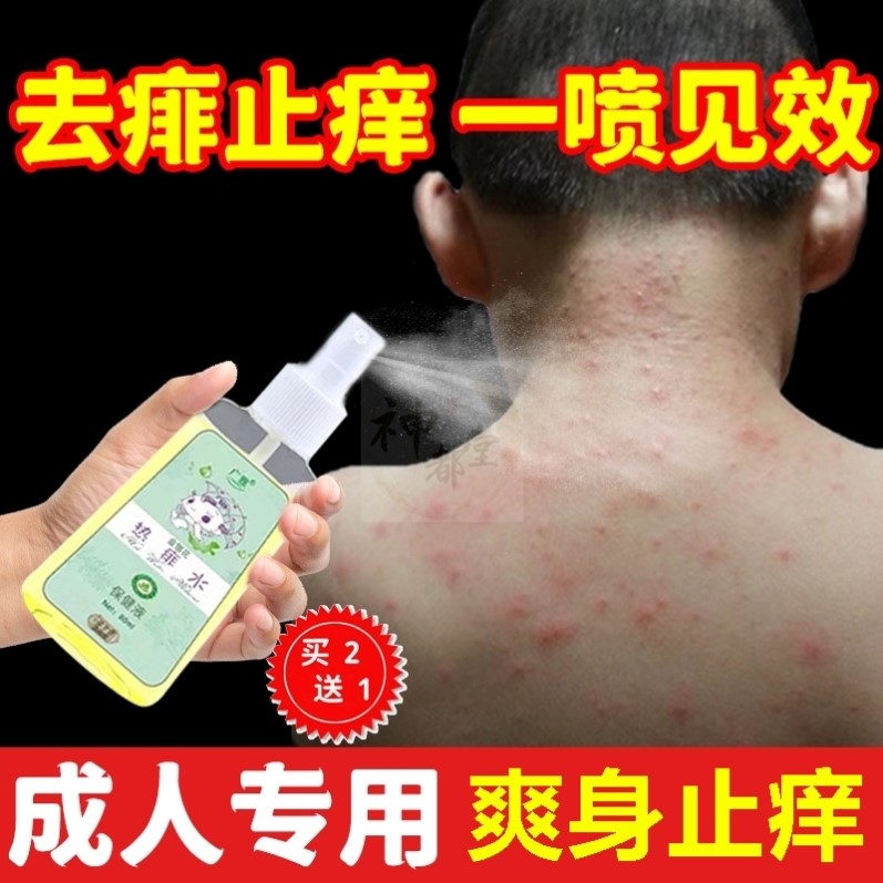 痱子止痒水喷雾成人去痱子粉祛痱膏治热痱子水大人儿童防菲神器