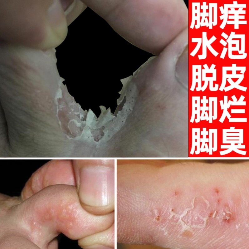 脚湿疹止痒去根脚背痒脚起泡药膏专用鲜喷剂脱皮烂脚丫药膏