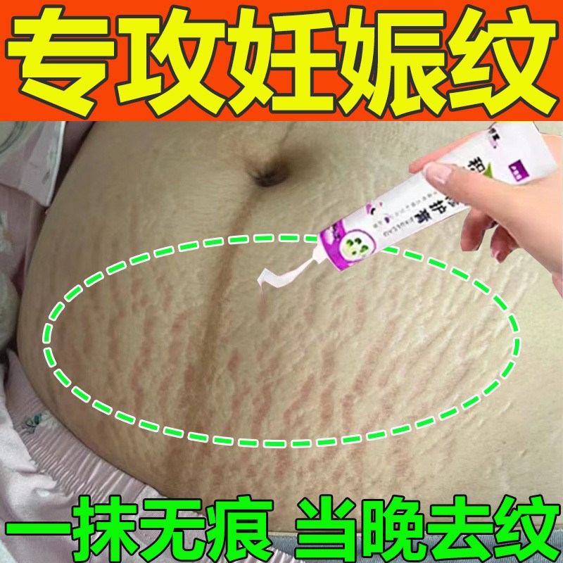 去妊娠纹遮挡淡化妊娠纹产后消除紧致妊娠纹淡化肥胖纹修复霜药膏