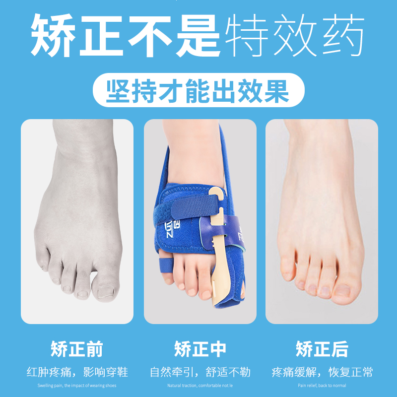 供大脚趾外翻矫正器拇指外翻矫形C器分趾器男女R士分离大脚骨纠正