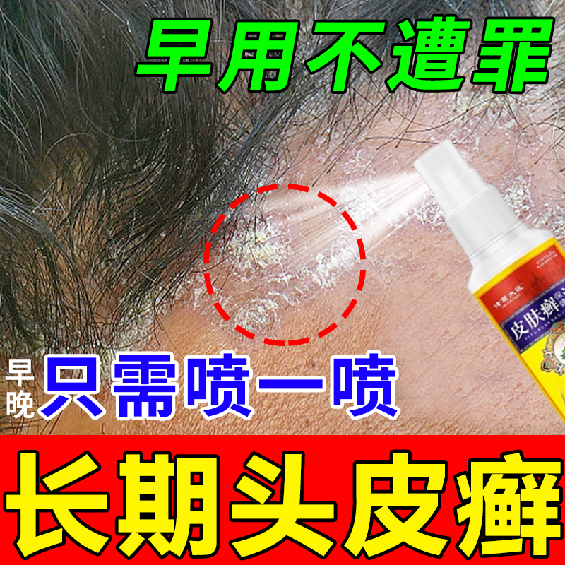 头皮癣药膏真菌感染脂溢性皮炎