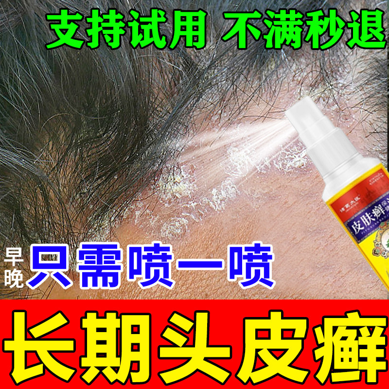 头皮癣银屑病头皮发痒脂溢性皮炎毛囊炎银屑痘头屑头痒结痂喷雾剂