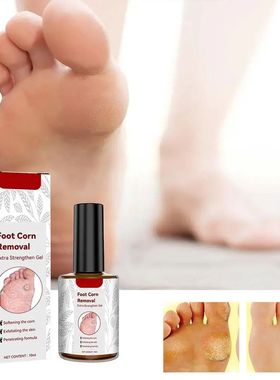 10ml Foot Corn Remover Cream Chicken Eye Skin Infection atme
