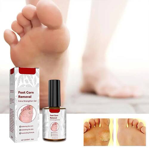 10ml Foot Corn Remover Cream Chicken Eye Skin Infection atme