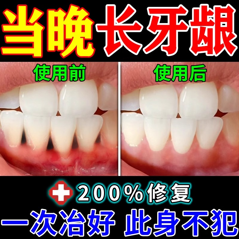 牙龈萎缩修复再生特效药牙齿松动黑三角牙周炎医用型填充专用牙膏