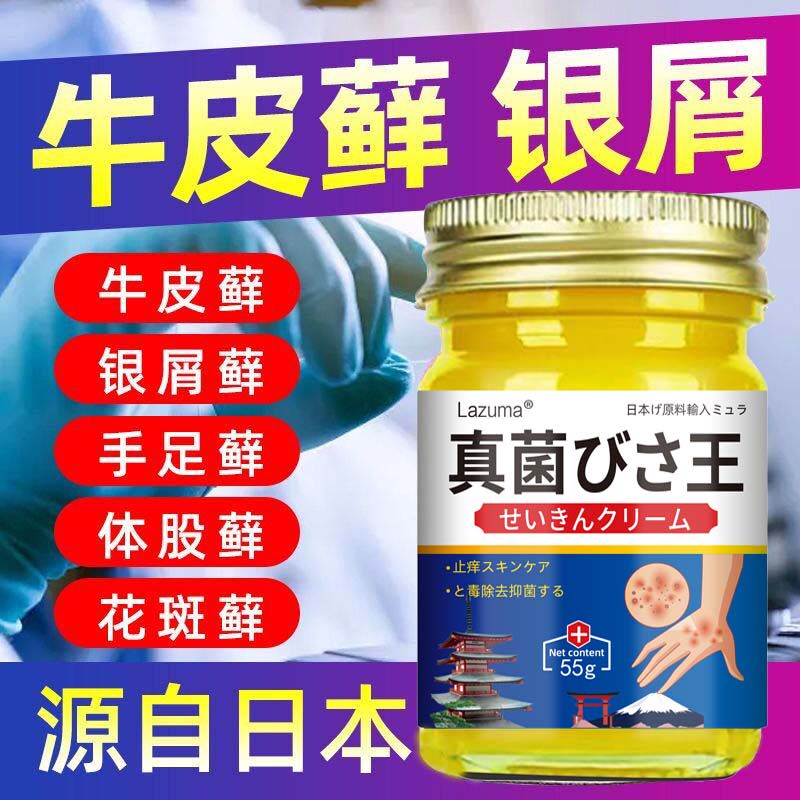 真菌王牛皮癣银屑癣体股癣手足癣头皮癣脚癣皮炎湿疹膏牛皮癣外用
