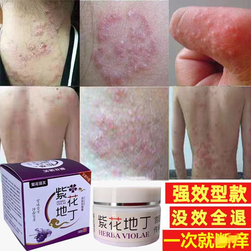 紫花地丁透皮百草膏软膏湿清小乳膏皮肤瘙痒全身干燥痒毒狼毒外用