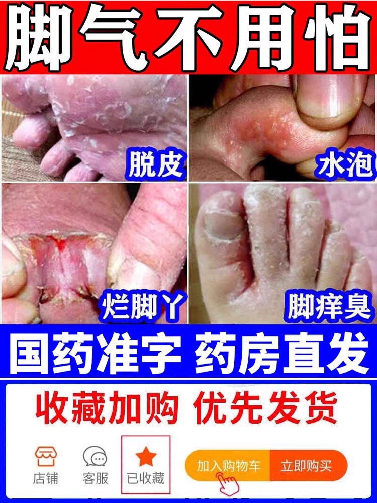 治疗脚气止痒真菌感染水泡型足光散粉去泡脚药包脚痒脱皮YY正品药