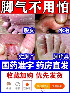 治疗脚气止痒真菌感染水泡型足光散粉去泡脚药包脚痒脱皮YY正品药