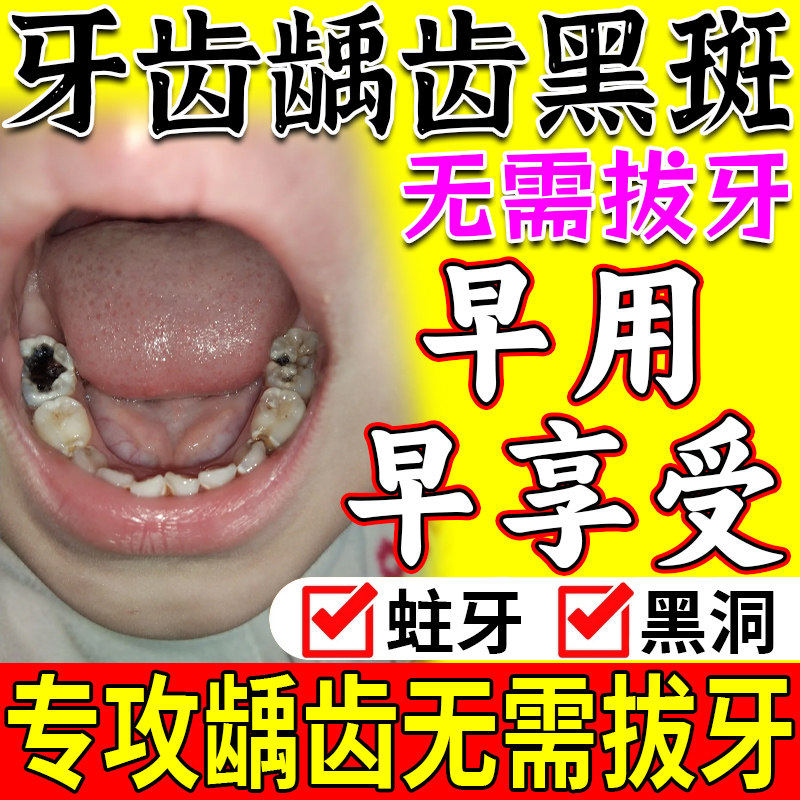 医用蛀牙龋齿修复膏防蛀牙修复牙补龋齿去黑线黑斑成人儿童防龋膏