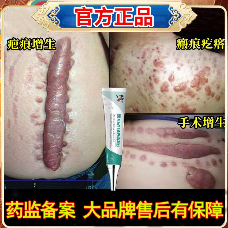 医用祛疤膏疤痕增生凸起正品