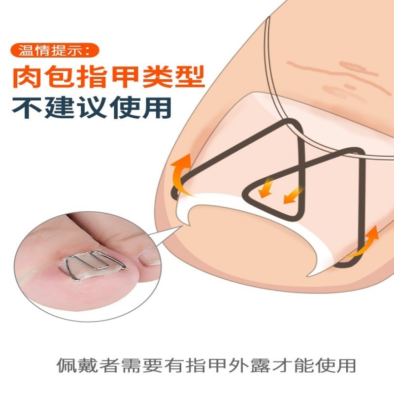脚趾甲正甲丝甲沟嵌甲矫正器指甲往肉里长拉拉卷甲正甲勾修脚工具,家庭/个人清洁工具,美甲/修甲套装,淘宝优惠券,粉丝福利购,淘宝优惠卷