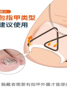 脚趾甲正甲丝甲沟嵌甲矫正器指甲往肉里长拉拉卷甲正甲勾修脚工具