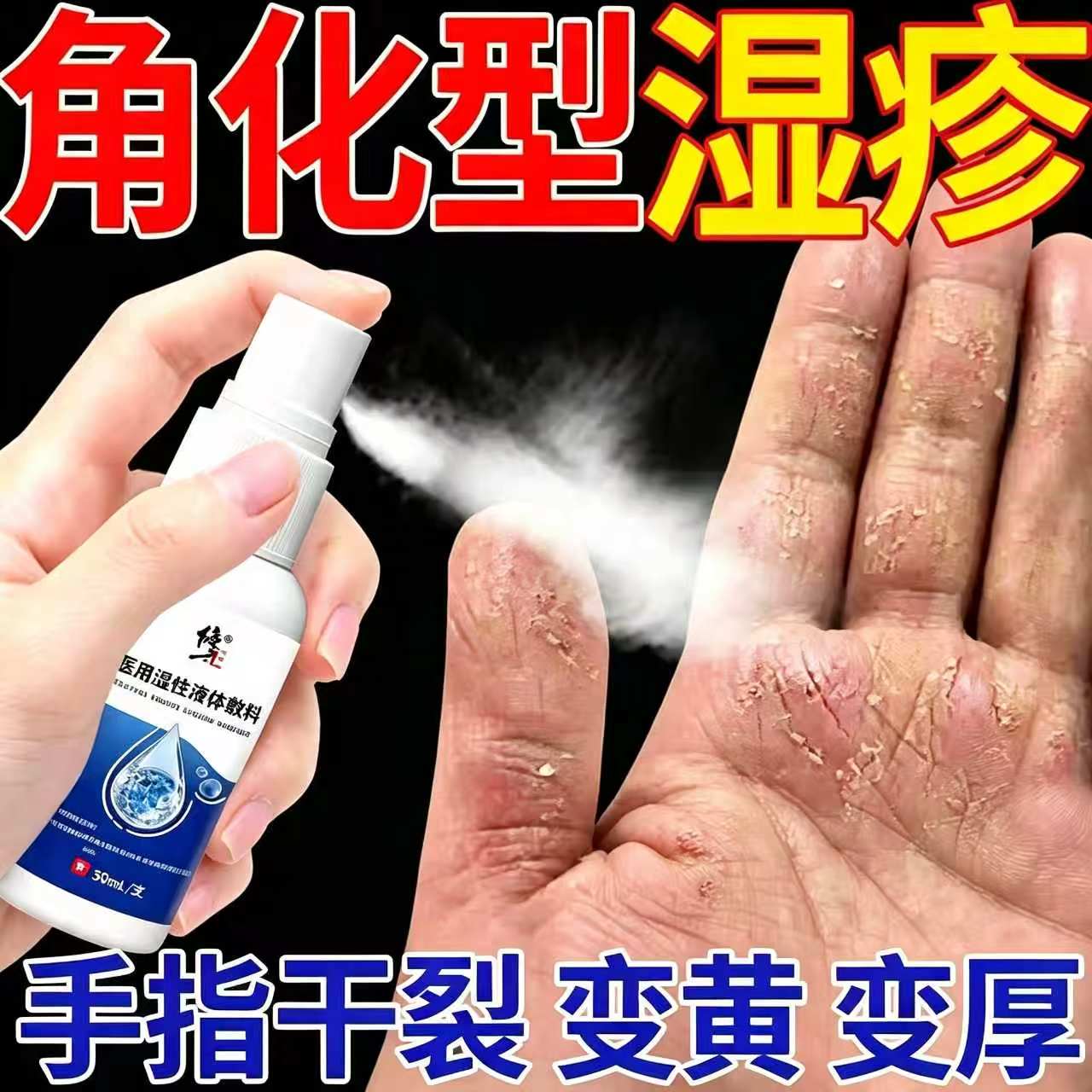 角化型湿疹手部脱皮干裂手癣鹅掌风真菌感染皲裂性止痒喷剂