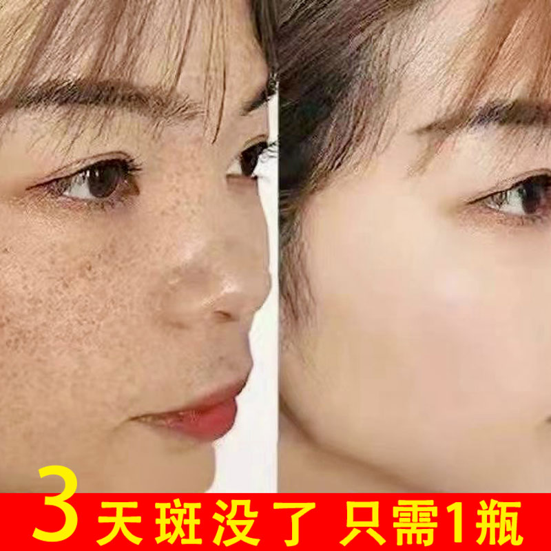 【屈臣氏热卖】祛脸上黑点斑点 斑迹 脸上干干净净 跟斑点说拜拜