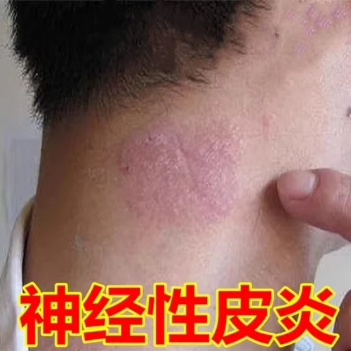 顽皮藓治疗牛皮癣银屑病皮肤去湿疹止瘙痒根神经性皮炎专外用药膏