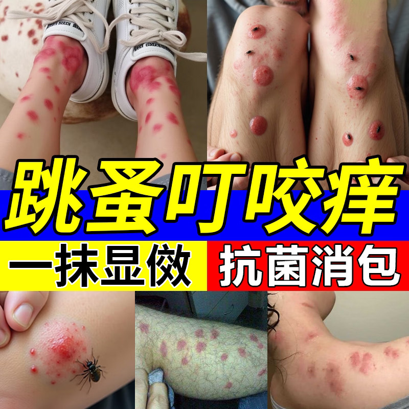 跳蚤咬止痒喷雾瘙痒红肿专用特效虫卵双杀驱防跳蚤膏人用被跳蚤