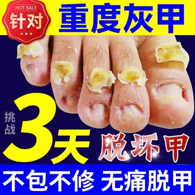 阿莫罗正品芳茶剂趾甲坏甲空甲烂灰指空甲增厚发黄快速修复抑菌