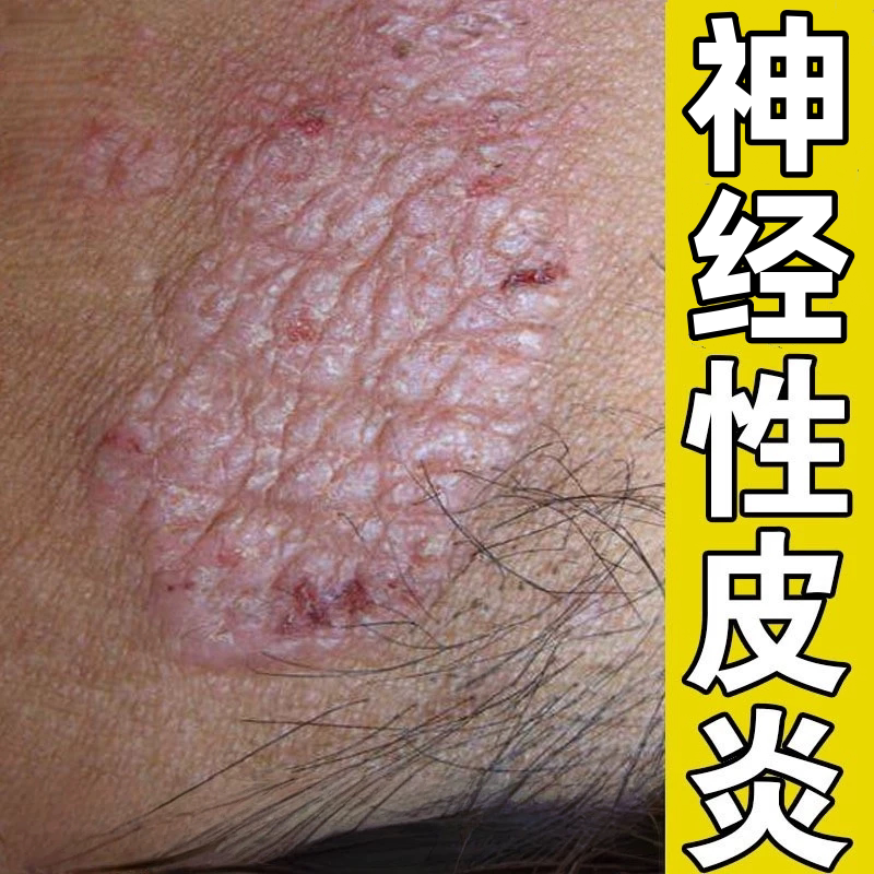 神经性皮炎外用去祛除皮肤藓疹真菌感染顽固无激素湿膏官方旗舰店