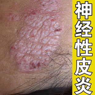神经性皮炎外用去祛除皮肤藓疹真菌感染顽固无激素湿膏官方旗舰店