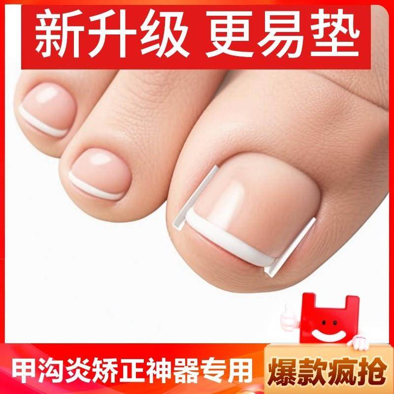 甲沟矫正器贴片炎嵌甲神器防脚指甲往肉里长专用治疗工具填充垫片,家庭/个人清洁工具,指甲钳,淘宝优惠券,粉丝福利购,淘宝优惠卷