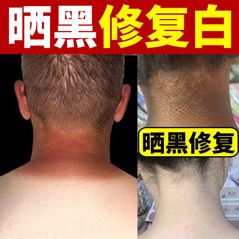 晒黑瞭修复快速变白神器防脖子手臂军训皮肤晒伤男女士美白精华霜
