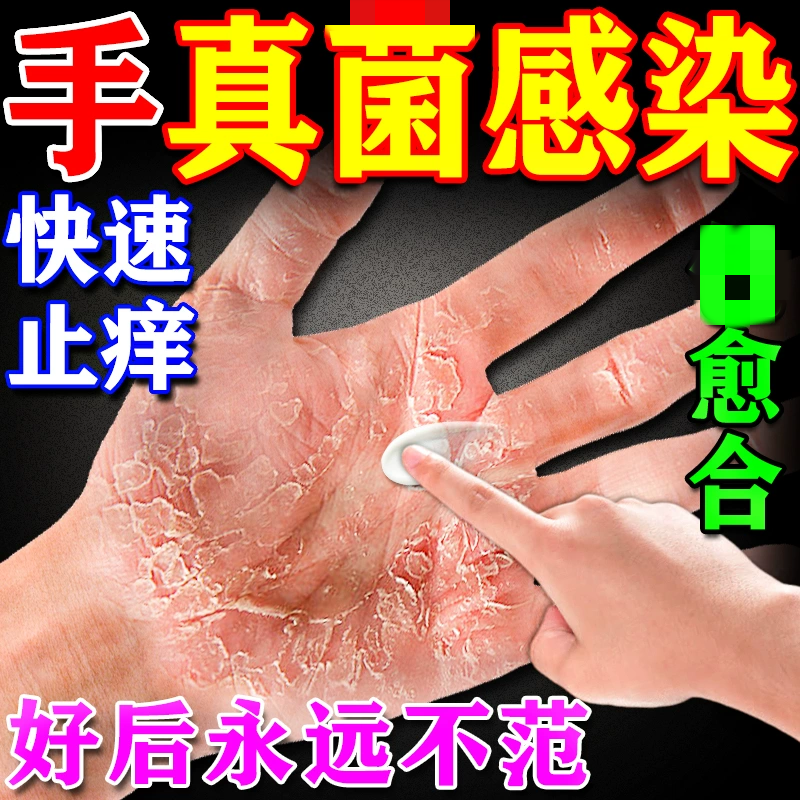 手藓膏脱皮干裂皮肤真菌感染效特膏药手上起小水泡汗状疹疱止痒膏