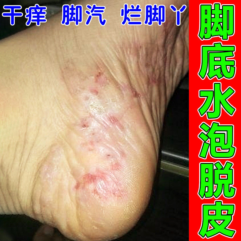 脚底上起小水泡感染脚掌痒干燥起皮水疱型脚臭烂脚趾缝用