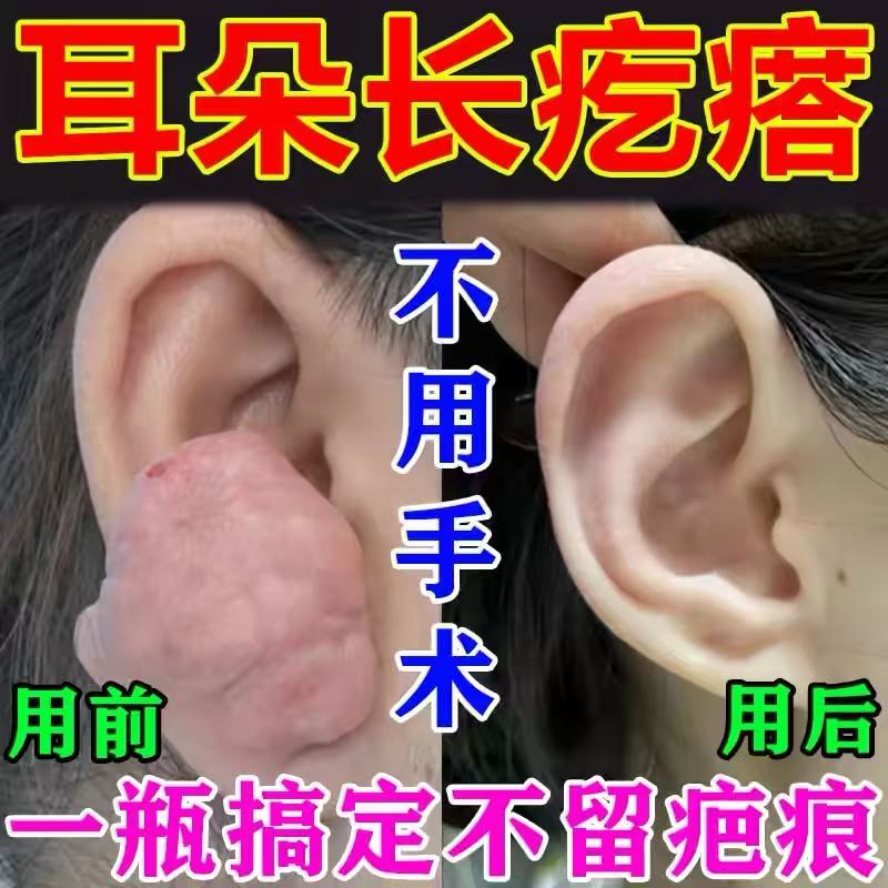 耳洞增生疙瘩疤痕去除液